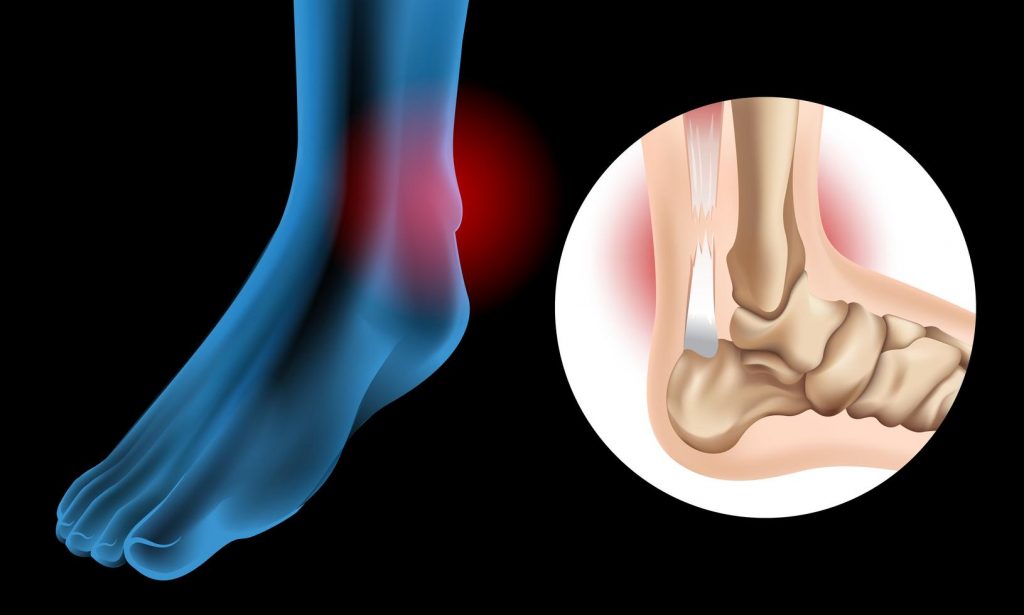 Diagram Showing Chronic Achilles Tendon Tear Vector